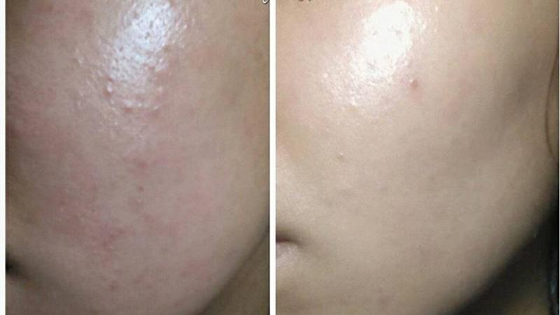 Da bị kích ứng khi mới sử dụng BHA